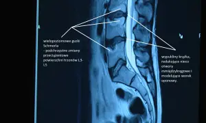Badanie MRI kręgosłupa ukazuje wielopoziomowe guzki Schmorla i wypukliny krążka, wpływające na otwory międzykręgowe. Poziome ustawienie kości krzyżowej nie jest widoczne.