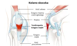 Ilustracja przedstawia anatomię kolana, ukazując problem "kolana skoczka" – zapalenie ścięgna rzepki.