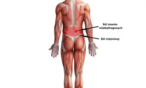 Anatomia pleców z zaznaczonym bólem stawów międzykręgowych i mięśniowym, wskazującym na hiperlordozę lędźwiową.