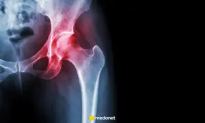 RTG miednicy z zaznaczonym bólem biodra, wskazującym na objaw Trendelenburga.