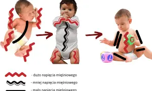 Od noworodka z wzmożonym napięciem mięśniowym, przez niemowlę w body, do dziecka bawiącego się klockami. Grafika pokazuje redukcję napięcia.