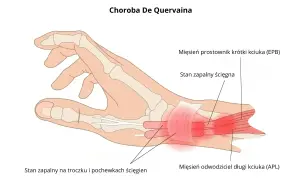 Anatomia dłoni z zaznaczonym zapaleniem ścięgien kciuka (choroba De Quervaina). Dowiedz się, ile trwa nadwyrężenie nadgarstka.