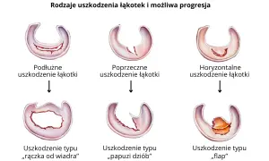 Ilustracja pokazuje różne rodzaje uszkodzeń łąkotki bocznej: podłużne, poprzeczne, horyzontalne, typu "rączka od wiadra", "papuzi dziób" i "flap".