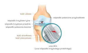 Anatomia kolana z zaznaczonym urazem ACL. Widoczne kości udowa, piszczelowa, strzałkowa oraz więzadła. Powiększenie ukazuje zerwane więzadło krzyżowe przednie.