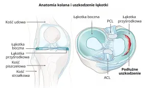 Anatomia kolana z widocznym podłużnym uszkodzeniem łąkotki przyśrodkowej.