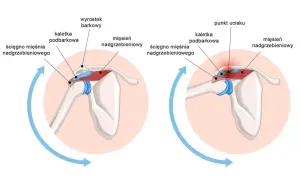 Anatomia barku: mięsień nadgrzebieniowy, ścięgno mięśnia nadgrzebieniowego i kaletka podbarkowa. Po prawej widać punkt ucisku.