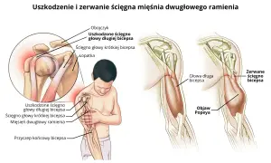 Ilustracja pokazuje uszkodzenie i zerwanie ścięgna mięśnia dwugłowego ramienia (bicepsa), w tym objaw Popeya.