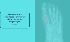 Rentgen stopy ukazujący złamanie kości śródstopia. Tekst informuje o przyczynach, objawach, leczeniu i diagnostyce.
