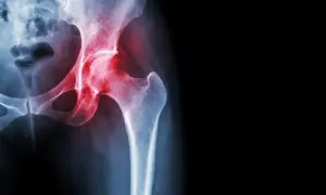 RTG miednicy z zaznaczonym bólem stawu biodrowego, wskazującym na objaw Duchenne'a.