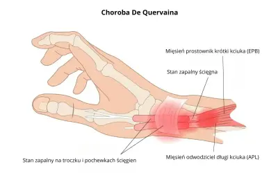 Anatomia dłoni z zaznaczonym zapaleniem ścięgien kciuka (choroba De Quervaina). Dowiedz się, ile trwa nadwyrężenie nadgarstka.