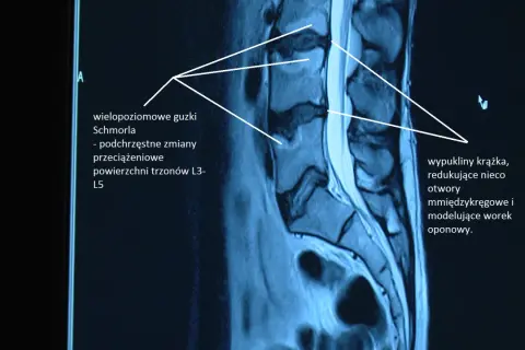 Badanie MRI kręgosłupa ukazuje wielopoziomowe guzki Schmorla i wypukliny krążka, wpływające na otwory międzykręgowe. Poziome ustawienie kości krzyżowej nie jest widoczne.
