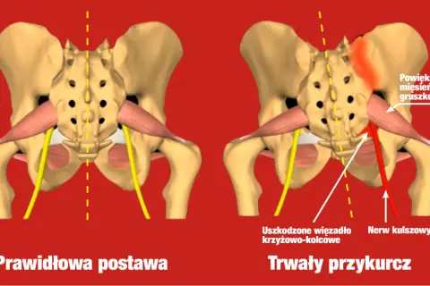 Powiększony mięsień gruszkowaty uciska nerw kulszowy, powodując trwały przykurcz.