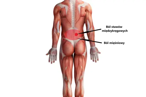 Anatomia pleców z zaznaczonym bólem stawów międzykręgowych i mięśniowym, wskazującym na hiperlordozę lędźwiową.