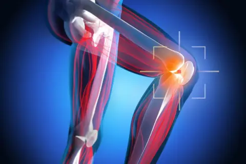 Anatomia kolana z zaznaczonym bólem, sugerującym nieleczone zerwane więzadło krzyżowe. Czerwone linie wskazują na uszkodzone tkanki.