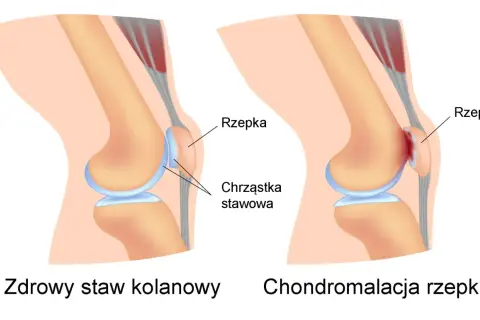 Porównanie zdrowego stawu kolanowego z zaawansowaną chondropatią 3 stopnia kolana, gdzie chrząstka jest mocno uszkodzona.