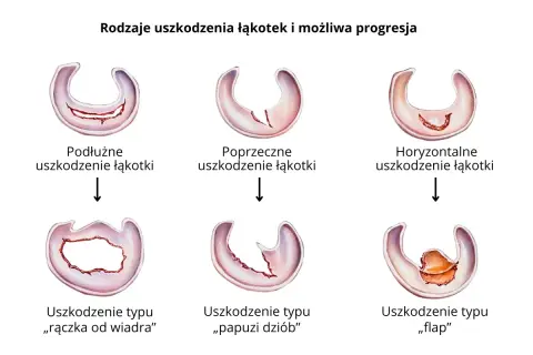 Ilustracja pokazuje różne rodzaje uszkodzeń łąkotki bocznej: podłużne, poprzeczne, horyzontalne, typu "rączka od wiadra", "papuzi dziób" i "flap".