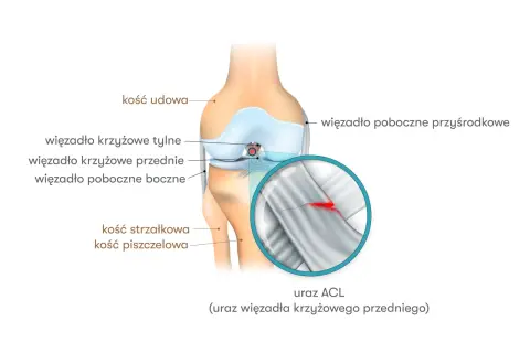 Anatomia kolana z zaznaczonym urazem ACL. Widoczne kości udowa, piszczelowa, strzałkowa oraz więzadła. Powiększenie ukazuje zerwane więzadło krzyżowe przednie.