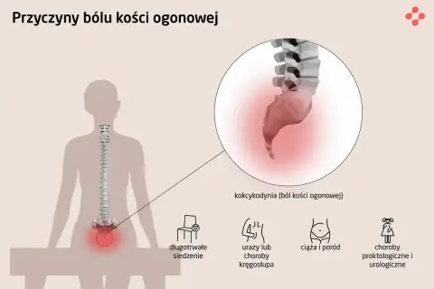 Ból kości ogonowej (kokcygodynia) może być spowodowany długotrwałym siedzeniem, urazami, ciążą lub chorobami. Na ilustracji zaznaczono kość krzyżową.