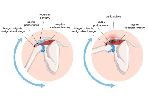 Anatomia barku: mięsień nadgrzebieniowy, ścięgno mięśnia nadgrzebieniowego i kaletka podbarkowa. Po prawej widać punkt ucisku.