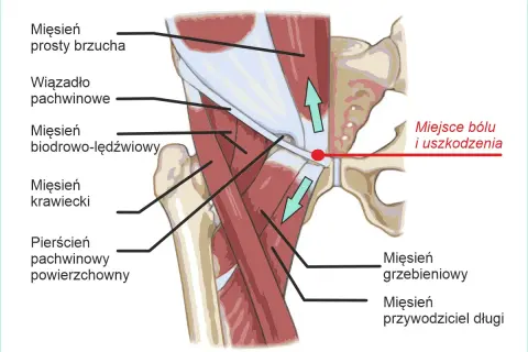 Anatomia pachwiny z zaznaczonym miejscem bólu. Widoczny mięsień grzebieniowy, przywodziciel długi, biodrowo-lędźwiowy, krawiecki, prosty brzucha, wiązadło pachwinowe i pierścień pachwinowy.