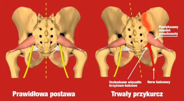 Powiększony mięsień gruszkowaty uciska nerw kulszowy, powodując trwały przykurcz.