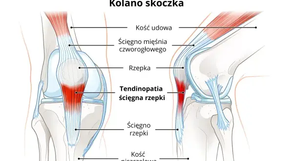 Ilustracja przedstawia anatomię kolana, ukazując problem "kolana skoczka" – zapalenie ścięgna rzepki.