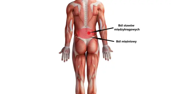 Anatomia pleców z zaznaczonym bólem stawów międzykręgowych i mięśniowym, wskazującym na hiperlordozę lędźwiową.
