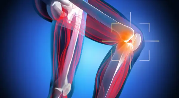 Anatomia kolana z zaznaczonym bólem, sugerującym nieleczone zerwane więzadło krzyżowe. Czerwone linie wskazują na uszkodzone tkanki.