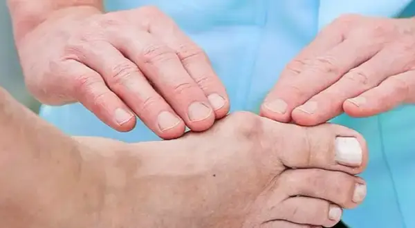 Jakie ćwiczenia po operacji palucha sztywnego pomogą w rehabilitacji?