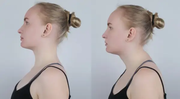 Dwie fotografie profilowe kobiety: po lewej z prostą postawą, po prawej z widocznym **wdowim garbem** i zaokrąglonymi plecami.