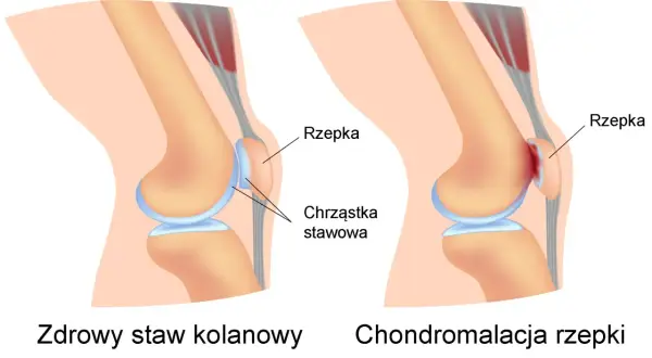 Porównanie zdrowego stawu kolanowego z zaawansowaną chondropatią 3 stopnia kolana, gdzie chrząstka jest mocno uszkodzona.