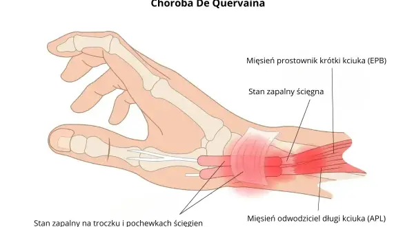 Anatomia dłoni z zaznaczonym zapaleniem ścięgien kciuka (choroba De Quervaina). Dowiedz się, ile trwa nadwyrężenie nadgarstka.