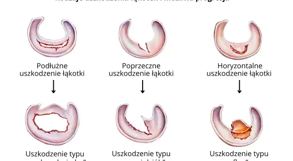 Ilustracja pokazuje różne rodzaje uszkodzeń łąkotki bocznej: podłużne, poprzeczne, horyzontalne, typu "rączka od wiadra", "papuzi dziób" i "flap".