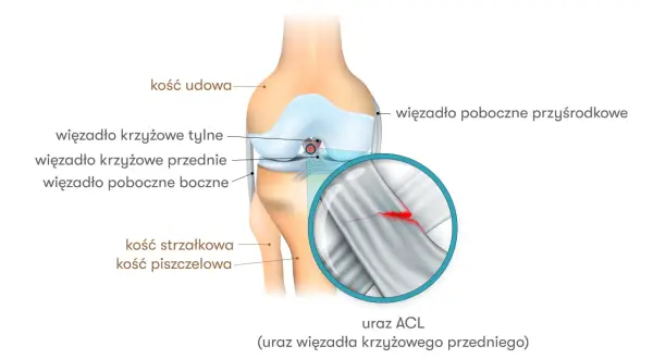 Anatomia kolana z zaznaczonym urazem ACL. Widoczne kości udowa, piszczelowa, strzałkowa oraz więzadła. Powiększenie ukazuje zerwane więzadło krzyżowe przednie.