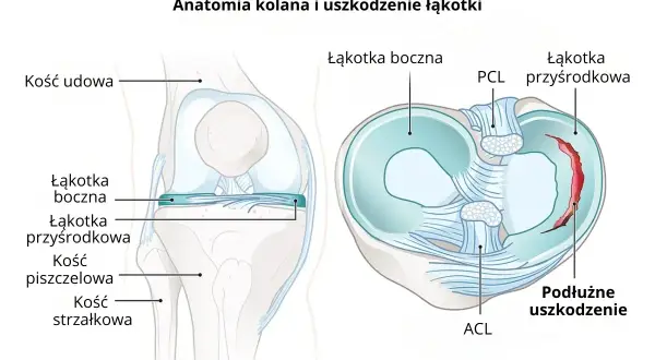 Anatomia kolana z widocznym podłużnym uszkodzeniem łąkotki przyśrodkowej.