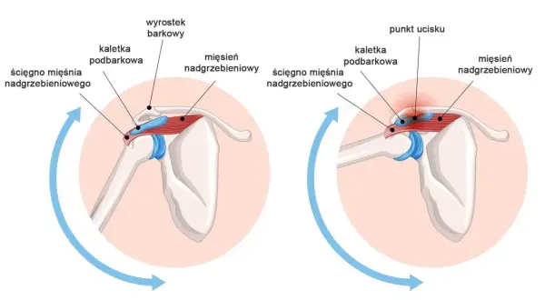 Anatomia barku: mięsień nadgrzebieniowy, ścięgno mięśnia nadgrzebieniowego i kaletka podbarkowa. Po prawej widać punkt ucisku.