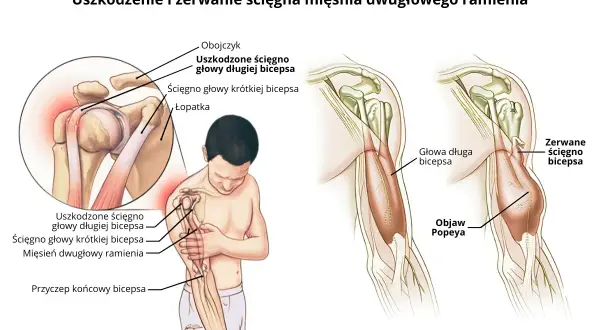 Ilustracja pokazuje uszkodzenie i zerwanie ścięgna mięśnia dwugłowego ramienia (bicepsa), w tym objaw Popeya.