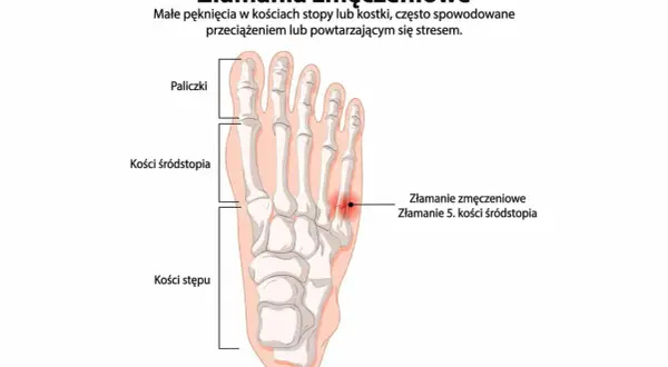 Złamanie zmęczeniowe 5. kości śródstopia, widoczne na schemacie stopy, to małe pęknięcie spowodowane przeciążeniem.