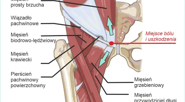 Anatomia pachwiny z zaznaczonym miejscem bólu. Widoczny mięsień grzebieniowy, przywodziciel długi, biodrowo-lędźwiowy, krawiecki, prosty brzucha, wiązadło pachwinowe i pierścień pachwinowy.