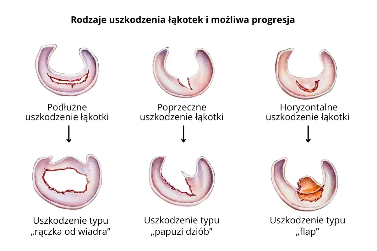 Ilustracja pokazuje różne rodzaje uszkodzeń łąkotki bocznej: podłużne, poprzeczne, horyzontalne, typu "rączka od wiadra", "papuzi dziób" i "flap".