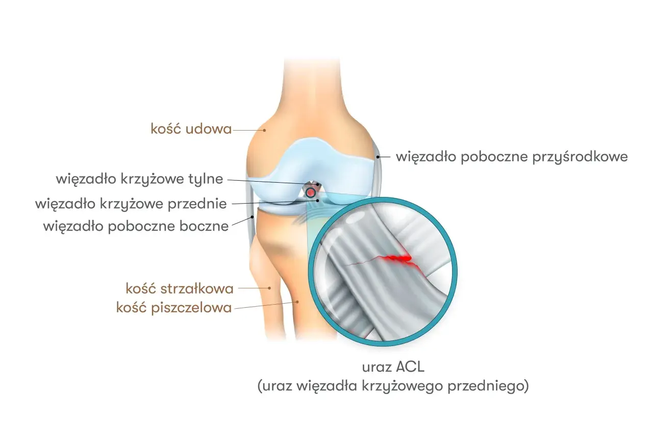 Anatomia kolana z zaznaczonym urazem ACL. Widoczne kości udowa, piszczelowa, strzałkowa oraz więzadła. Powiększenie ukazuje zerwane więzadło krzyżowe przednie.