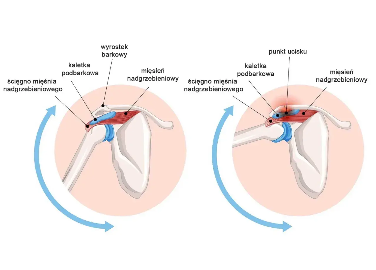 Anatomia barku: mięsień nadgrzebieniowy, ścięgno mięśnia nadgrzebieniowego i kaletka podbarkowa. Po prawej widać punkt ucisku.