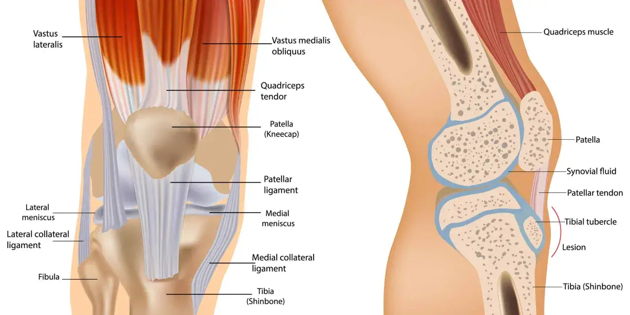 Anatomia kolana z zaznaczonymi strukturami, w tym chrząstką i płynem stawowym, ilustrująca zmiany w gonartrozie.