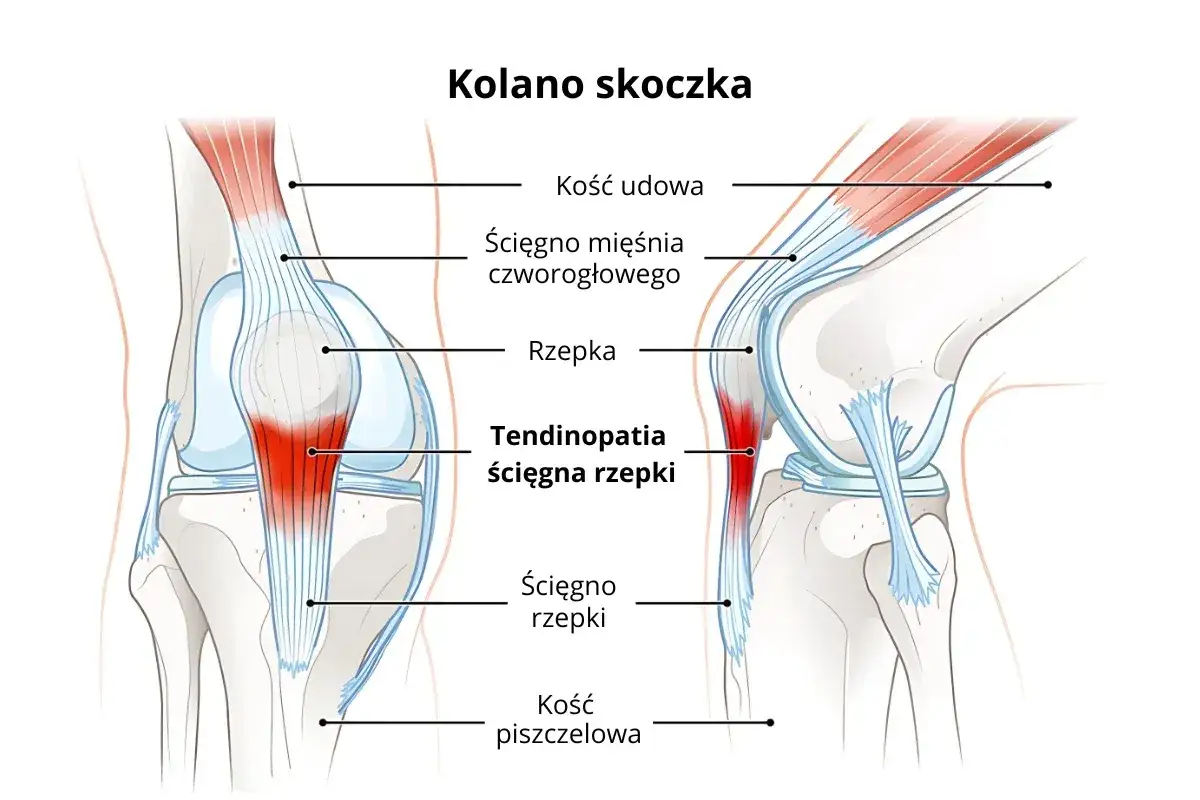 Ilustracja przedstawia anatomię kolana skoczka, z zaznaczoną tendinopatią ścięgna rzepki.