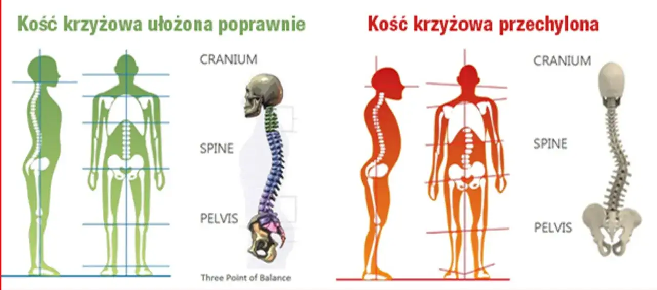 Porównanie prawidłowego, poziomego ustawienia kości krzyżowej z jej przechyleniem, ukazujące wpływ na kręgosłup.