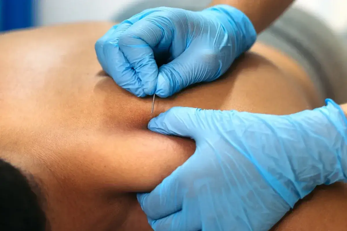 Terapeuta w niebieskich rękawiczkach wykonuje zabieg suchego igłowania na plecach pacjenta, wprowadzając cienką igłę w skórę.