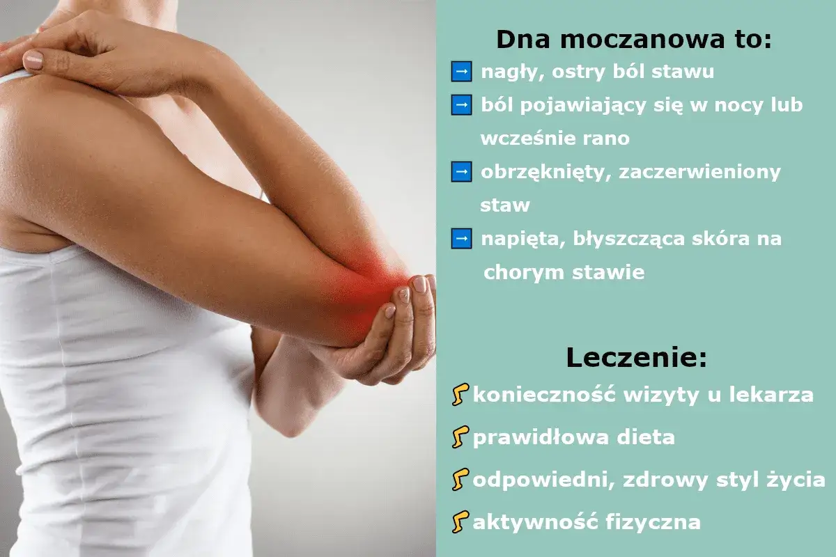 Dna moczanowa to ostry ból stawu, obrzęk i zaczerwienienie. Leczenie obejmuje dietę i aktywność fizyczną, co ułatwia chodzenie.