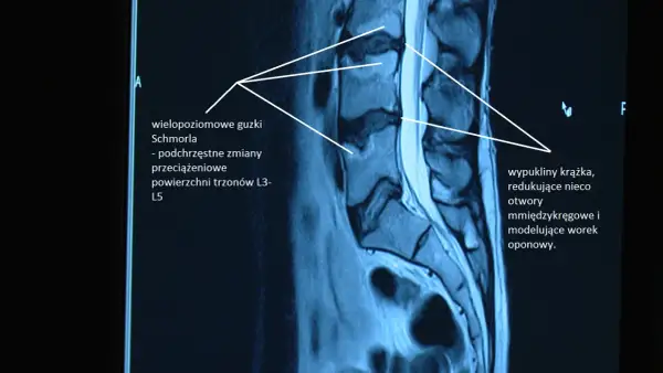 Badanie MRI kręgosłupa ukazuje wielopoziomowe guzki Schmorla i wypukliny krążka, wpływające na otwory międzykręgowe. Poziome ustawienie kości krzyżowej nie jest widoczne.