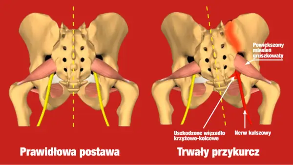 Powiększony mięsień gruszkowaty uciska nerw kulszowy, powodując trwały przykurcz.