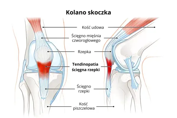 Ilustracja przedstawia anatomię kolana, ukazując problem "kolana skoczka" – zapalenie ścięgna rzepki.